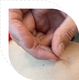 Acupunctuurbehandeling bij AllFlow - naald plaatsing
